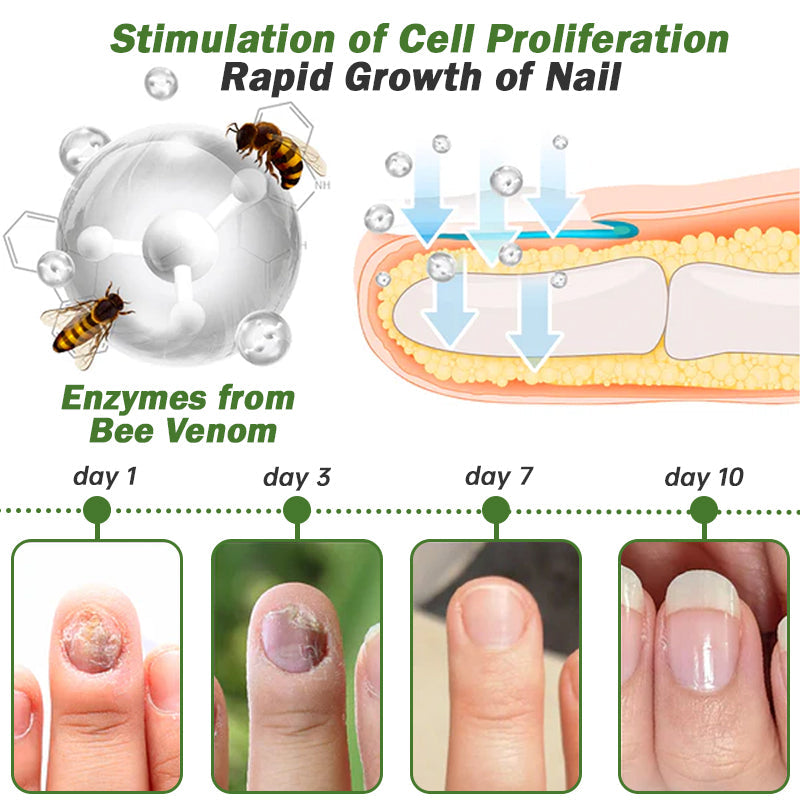 š¤ļøš©āāļøFurzero⢠Nail Defense Bee Venom Treatment Serum(For All Kinds Of Nail Diseasesā
For Healthier Nail Growth)