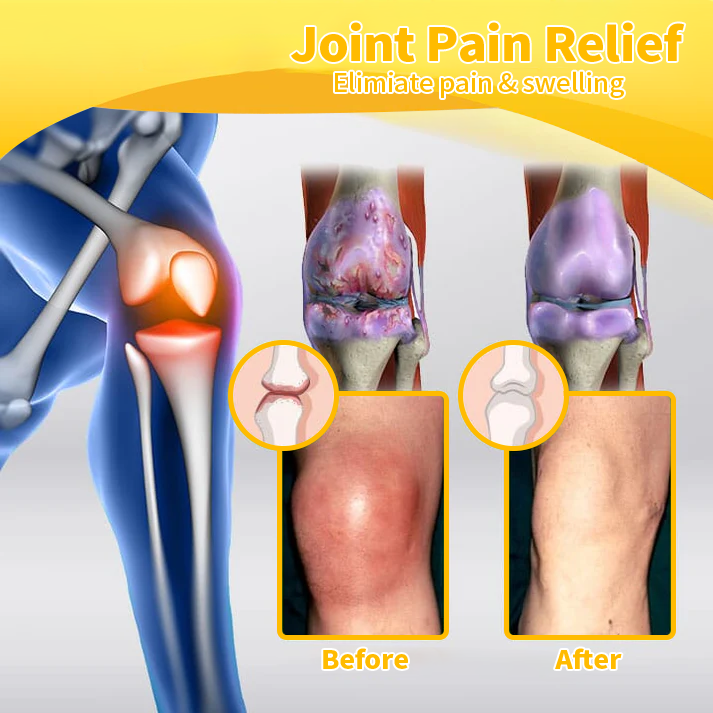 🌻Furzero™ Bee Venom Joint and Bone Cream (✨ Specially for orthopedic conditions and joint pain ✨)